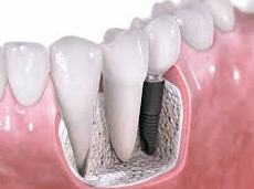 dental implant illustration 