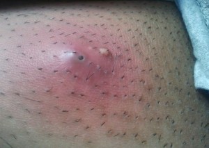 ingrown hair treatment