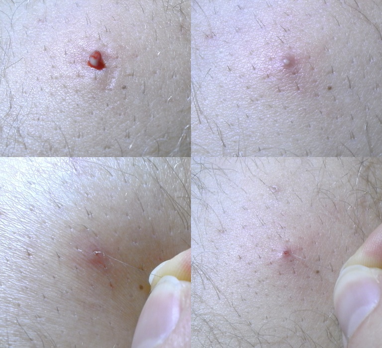 ingrown hair treatment result