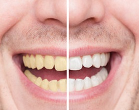 whitening teeth before after