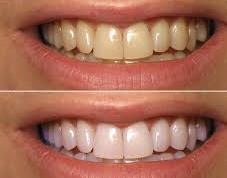 whitening teeth 