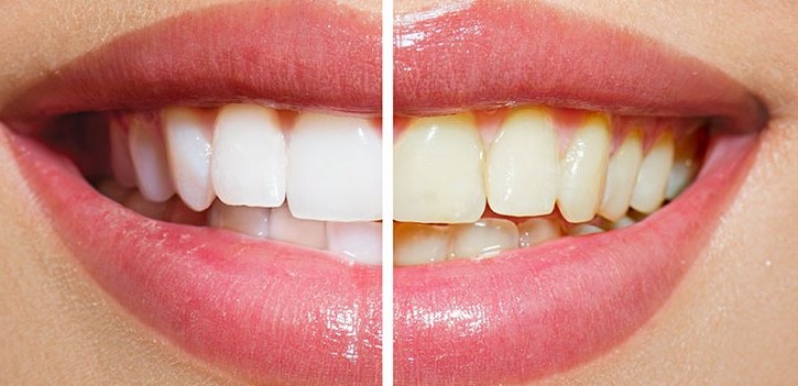 whitening teeth result