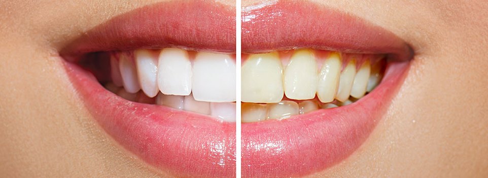 whitening teeth result