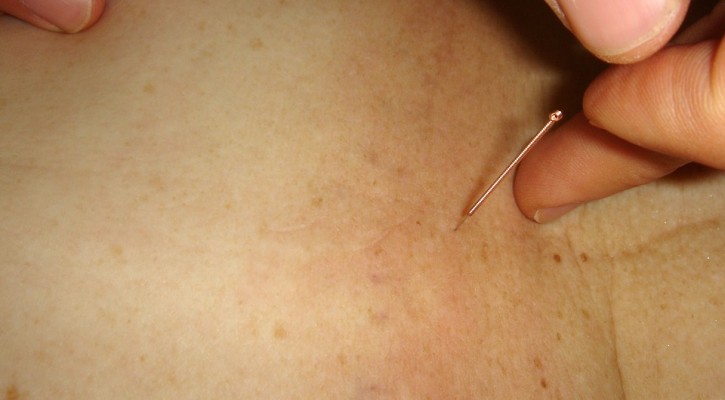 acupuncture